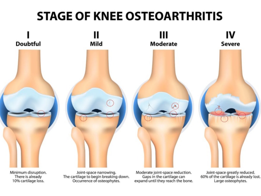 Ενδοσκοπική Κάψουλα για τον έλεγχο λεπτού εντέρου